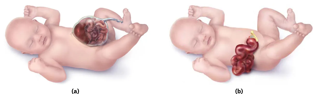 Illustrations of a newborn with birth defects. (a) A newborn with the intestines located outside of the body through an opening near the umbilical area. (b) A newborn with the absence of a covering membrane over the protruding intestines, which are to the right of the umbilicus.