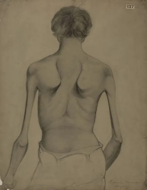 The image is a detailed pencil drawing of the back of a person with significant muscle atrophy. The individual is shown from behind, with visible wasting of the muscles around the shoulders, upper back, and arms. The shoulder blades (scapulae) are prominently protruding, and the spine is clearly visible due to the severe loss of muscle mass. The person’s hair is short, and they appear to be wearing a loose garment around the waist. The drawing is labeled with the number "137" in the upper right corner.