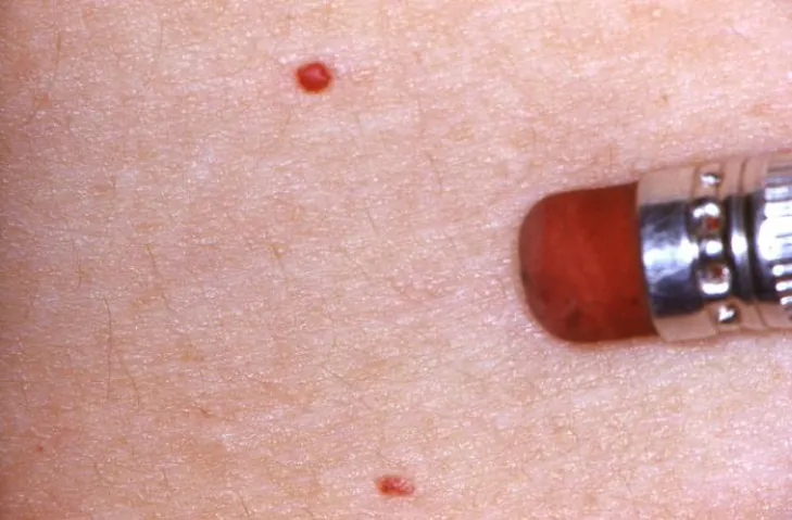 Photo of a Cherry hemangioma on a body part compared with the size of a pencil eraser.
