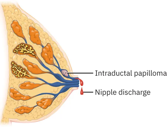 Image of breast with a growth inside one of the ducts and red discharge visible from the nipple.
