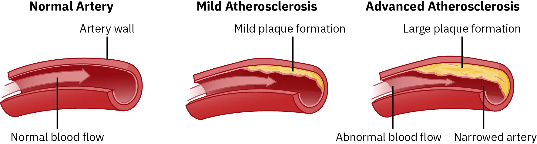 Three cutaway illustrations show what the artery wall looks like and how blood flows through it during different stages of atherosclerosis. The first illustrates a normal artery. The artery wall has no plaque formations inside of it and blood is able to flow through it unrestricted. The second illustrates an artery with mild atherosclerosis. There is mild plaque build up inside the artery wall, which restricts the blood flow slightly. The third illustrates an artery with advanced atherosclerosis. There is a lot of plaque build up inside the artery wall, reducing the space blood has to flow through by nearly half. This narrowed artery causes abnormal blood flow.