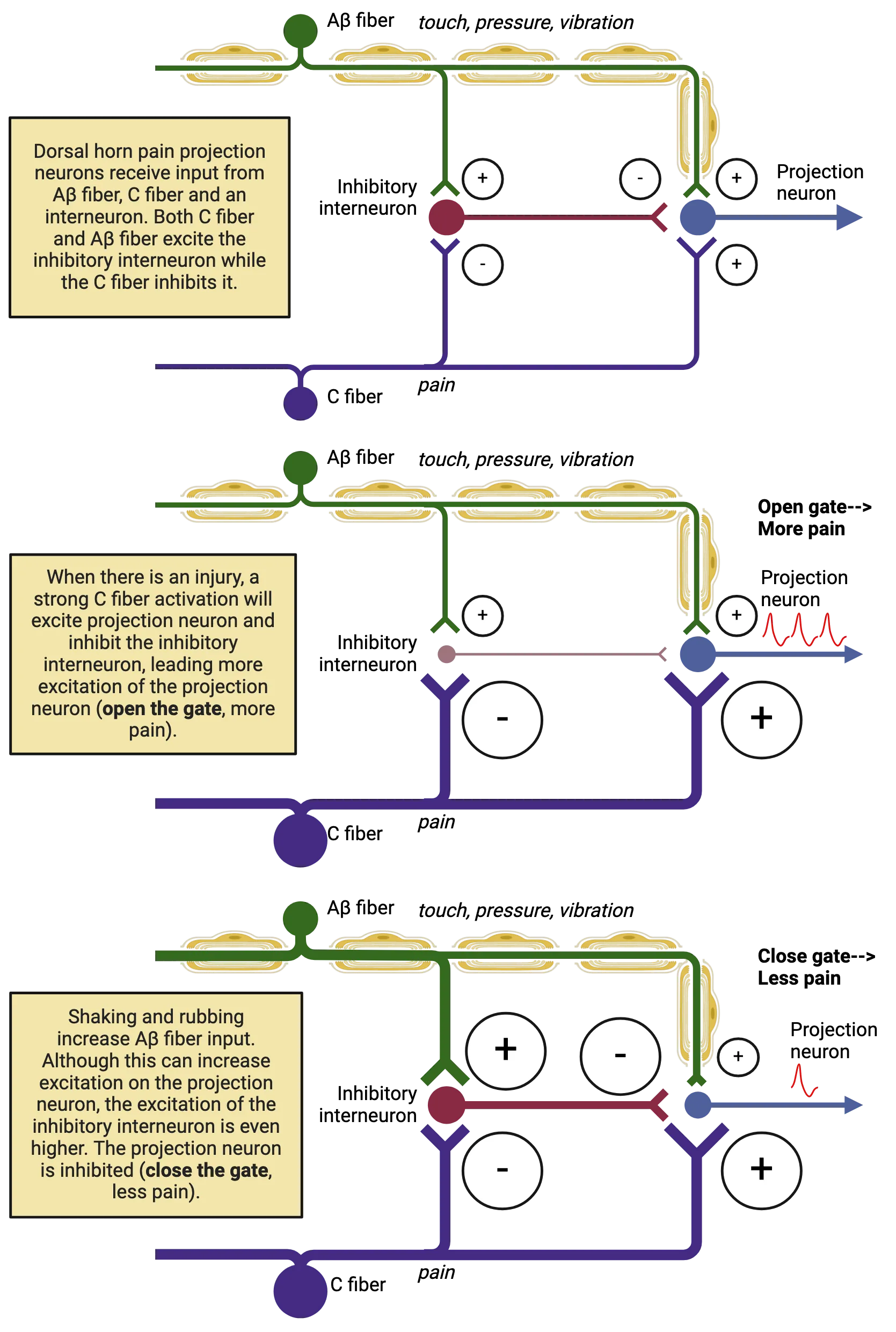 Top: A diagram of a neuronal circuit, showing connectivity of Ab touch fibers, C fibers, pain projection neuron and an inhibitory neuron. Middle: A diagram of a neuronal circuit, showing connectivity of Ab touch fibers, C fibers, pain projection neuron and an inhibitory neuron. C fiber is enlarged to suggest activation. Projection neuron fires more action potentials. Bottom: A diagram of a neuronal circuit, showing connectivity of Ab touch fibers, C fibers, pain projection neuron and an inhibitory neuron. C fiber is enlarged to suggest activation. Ab fiber is also enlarged. Projection neuron fires fewer action potentials.
