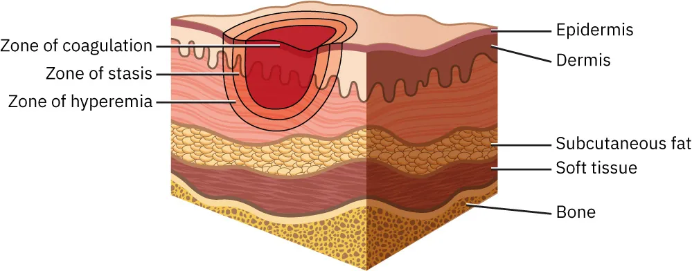 Diagram of zones of injury to skin from a burn, labeling Zone of coagulation, Zone of stasis, Zone of hyperemia, Epidermis, Dermis, Subcutaneous fat, Soft tissue, Bone.