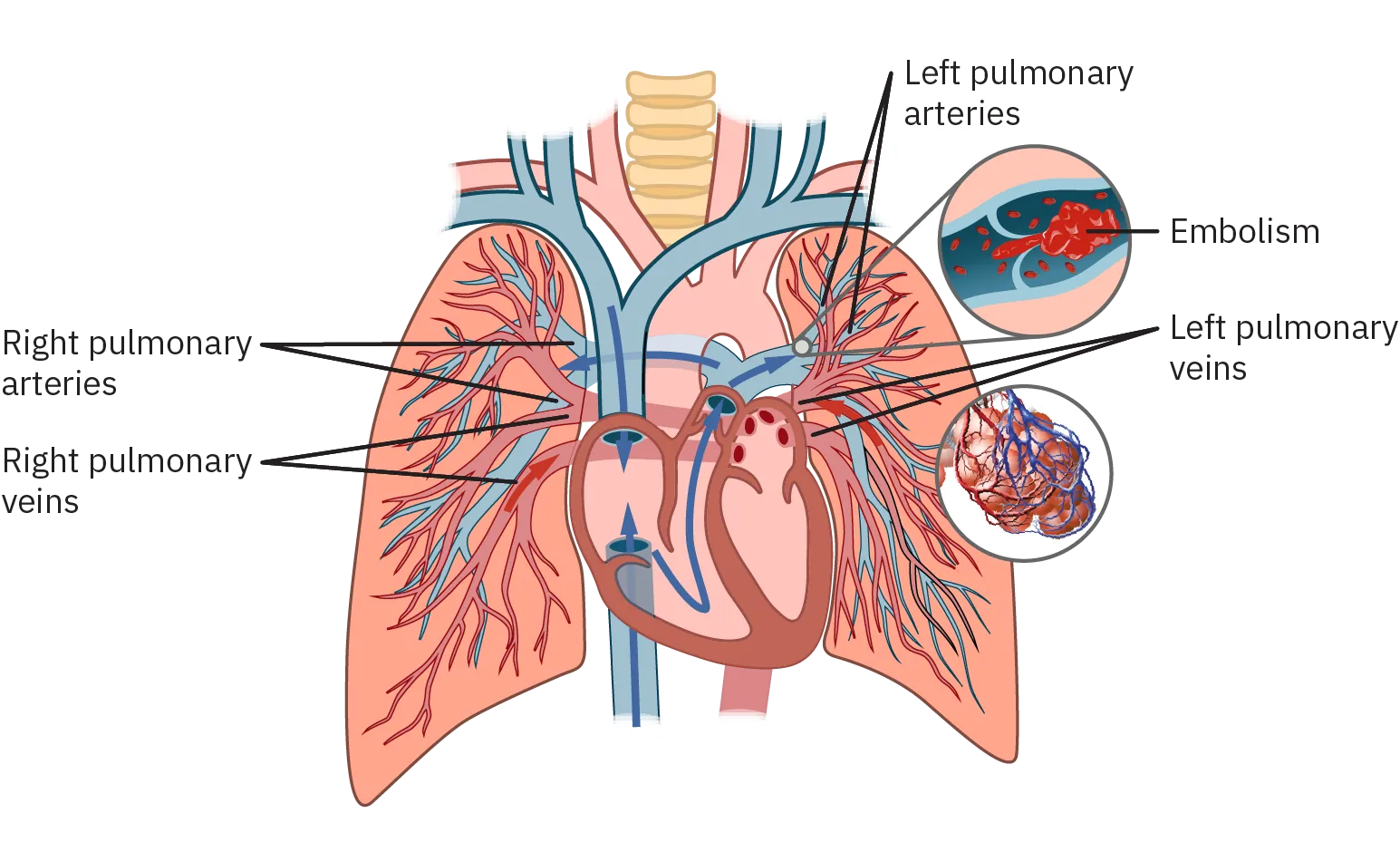 A diagram of the pulmonary arteries and veins in the lungs. A close up illustrates an embolism that is almost the entire width of the vein, blocking the flow of blood in the lungs.