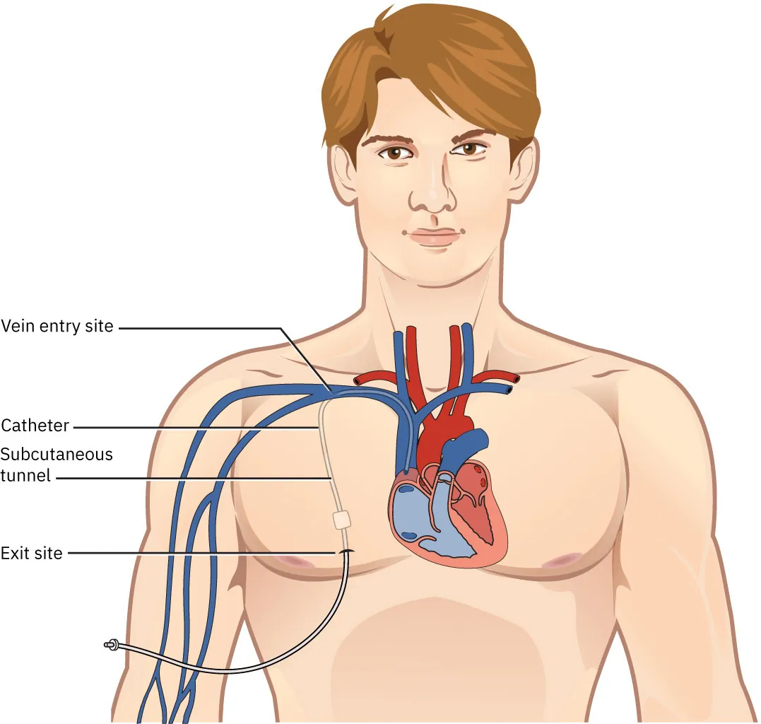 A diagram shows a head and torso with the heart and catheter shown. The labels include “Catheter,” “vein entry site,” “subcutaneous tunnel,” and “exit site.”