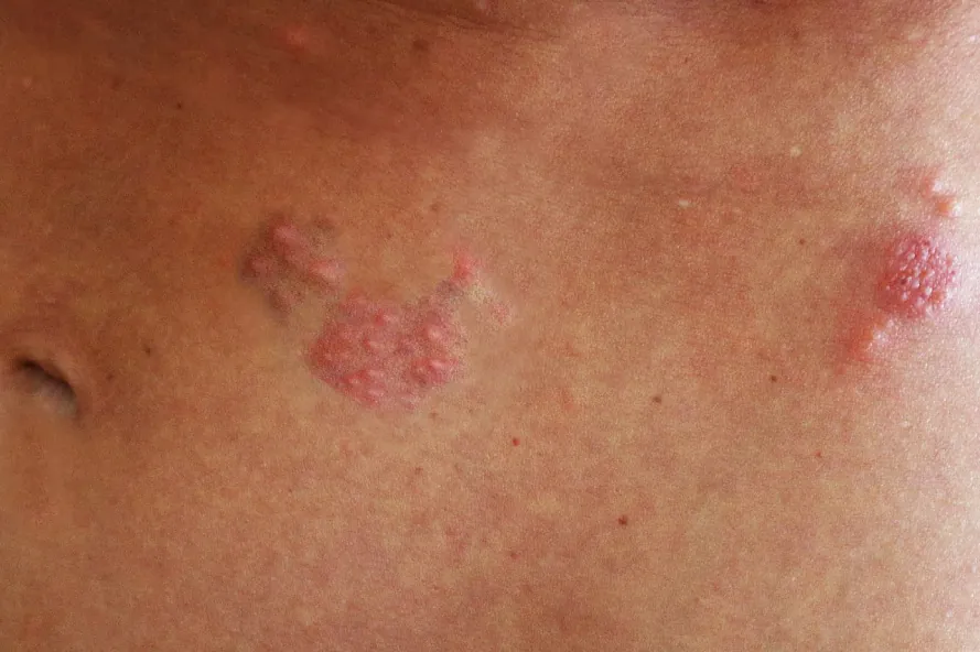 Close-up of skin with multiple clusters of red, raised, blister-like lesions, characteristic of a rash such as shingles, on a person's torso near the navel.