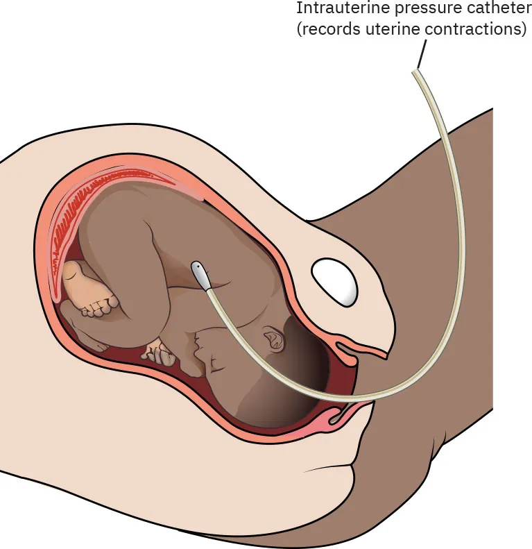 Diagram showing placement of intrauterine pressure catheter (records uterine contractions).