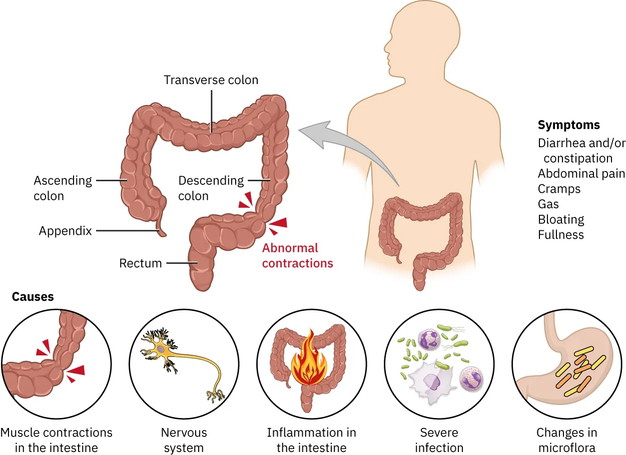 Illustration showing symptoms and causes of IBS; Symptoms: Diarrhea and/or constipation, Abdominal pain, Cramps, Gas, Bloating, Fullness; Causes: Muscle contractions in the intestine, Nervous system, Inflammation in the intestine, Severe infection, Changes in microflora; Diagram of colon labeled with Transverse colon, Ascending colon, Appendix, Descending colon, Rectum, and Abnormal contractions.