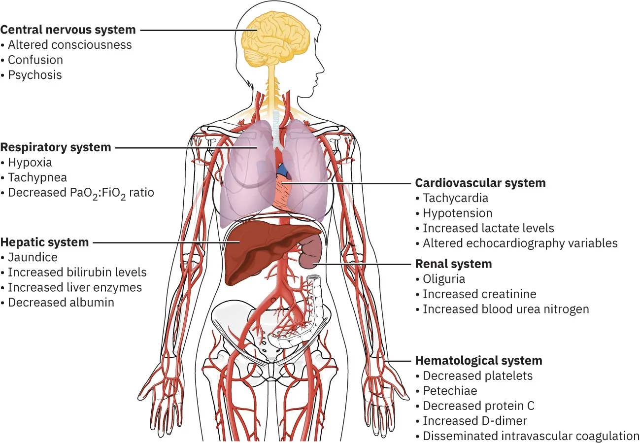 Diagram showing symptoms of multiorgan failure in various body systems; Central nervous system: altered consciousness, confusion, psychosis; Respiratory system: hypoxia, tachypnea, decreased PaO2:FiO2 ratio; Hepatic system: jaundice, increased bilirubin levels, increased liver enzymes, decreased albumin; Cardiovascular system: tachycardia, hypotension, increased lactate levels, altered echocardiography variables; Renal system: oliguria, increased creatine, increased blood urea nitrogen; Hematological system: decreased platelets, petchiae, decreased protein C, increased D-dimer, disseminated intravascular coagulation