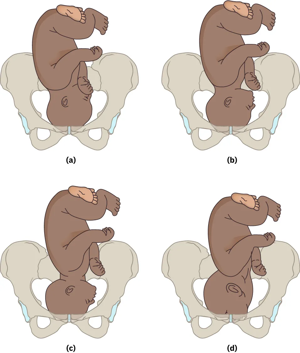 Fetal attitudes: (a) fetal chin tucked into chest, (b) fetal chin lifted, (c) fetal chin at 90 degree angle with cervix, and (d) fetal chin at cervix.