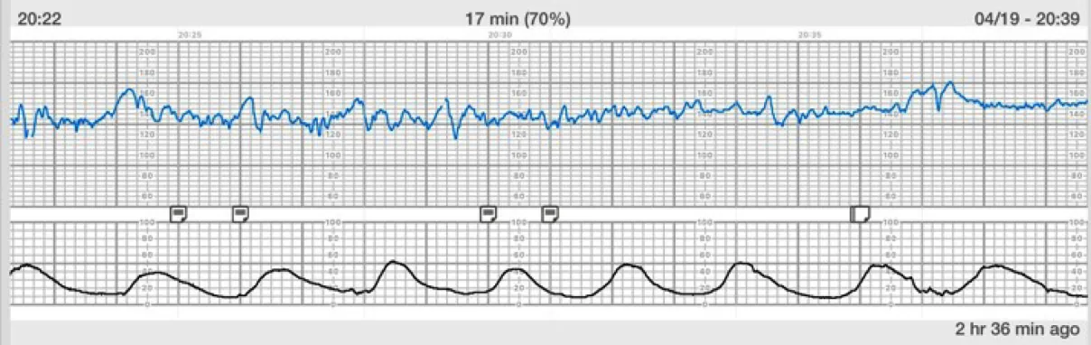 A tracing with two lines. The top line that shows the FHR is jagged and ranges from 110 bpm to 180 bpm in no apparent pattern. The bottom line is smoother with more time between the peaks and troughs and is shaped more like a wave. Peaks are at approximately 50, occurring about 2 minutes apart, and troughs are at approximately 10.