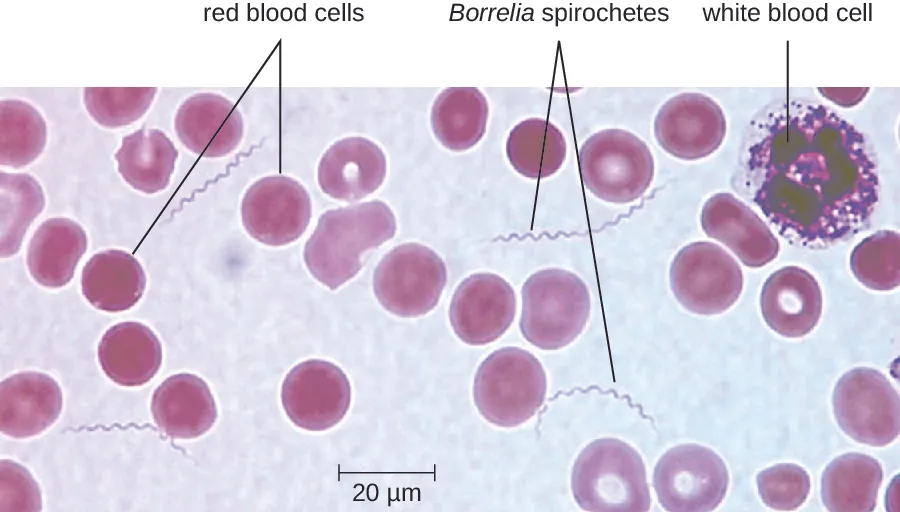 A micrograph showing red circles labeled red blood cells and larger white blood cells. Small spirals (approximately the length of 2 red blood cells; 20 µm) are labeled Borrelia spirochetes.