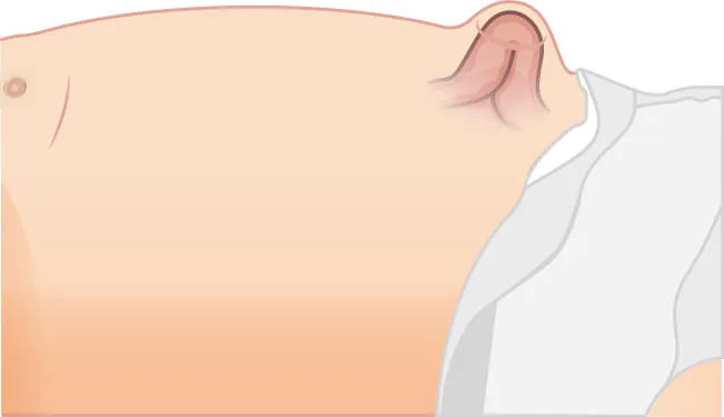 Image of an umbilical hernia shown under the infant’s skin.