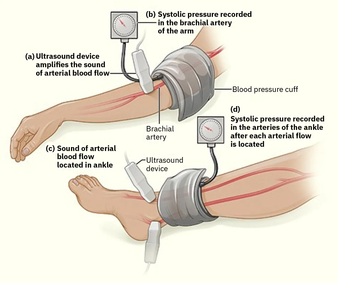 Diagram showing blood pressure cuffs on arms and legs, labeling (a) Ultrasound device amplifies the sound of arterial blood flow, (b) Systolic pressure recorded in the brachial artery of the arm, (c) Sound of arterial blood flow located in ankle, (d) Systolic pressure recorded in the arteries of the ankle after each arterial flow is located.