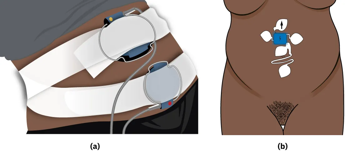 (a) Image of a pregnant stomach with straps around the top and bottom of the stomach holding two monitors in place. (b) Image of a pregnant stomach with six patches stuck around the center of the stomach.