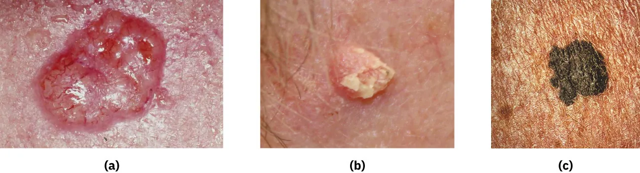 A series of photographs show (a) basal cell carcinoma, (b) squamous cell carcinoma, and (c) melanoma