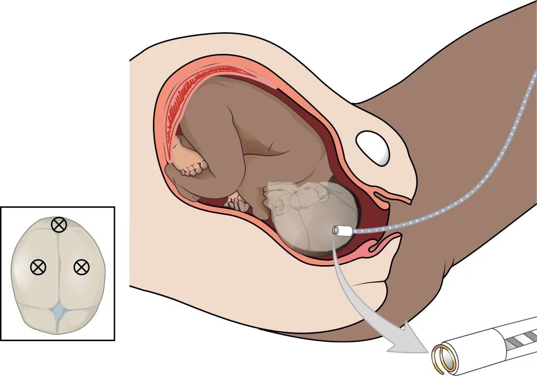 Diagram showing fetal scalp electrode placement.