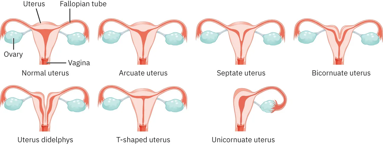 Image of various uterus abnormalities (displaying ovaries and vagina): Normal uterus, Arcuate uterus, Septate uterus, Bicornuate uterus, Uterus didelphys, T-shaped uterus, and Unicornuate uterus.
