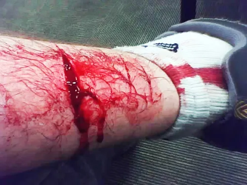 An image showing a large cut on an individual’s leg.