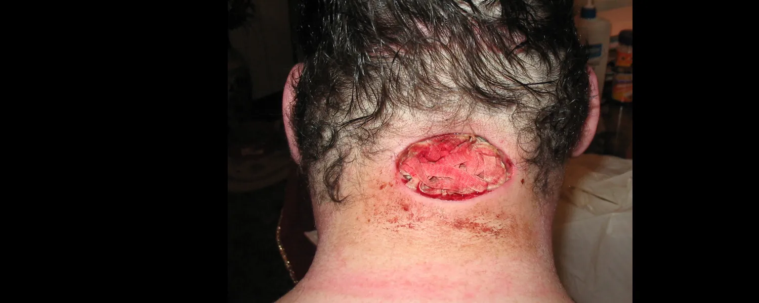 Example of a surgical wound on the back of the neck after being packed with gauze.