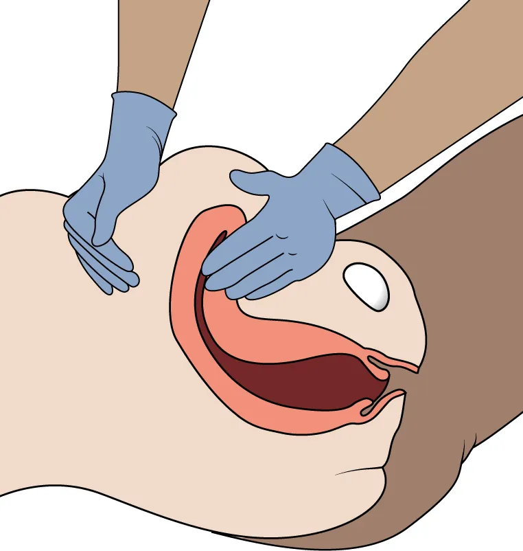 Diagram showing nurse performing fundal massage.