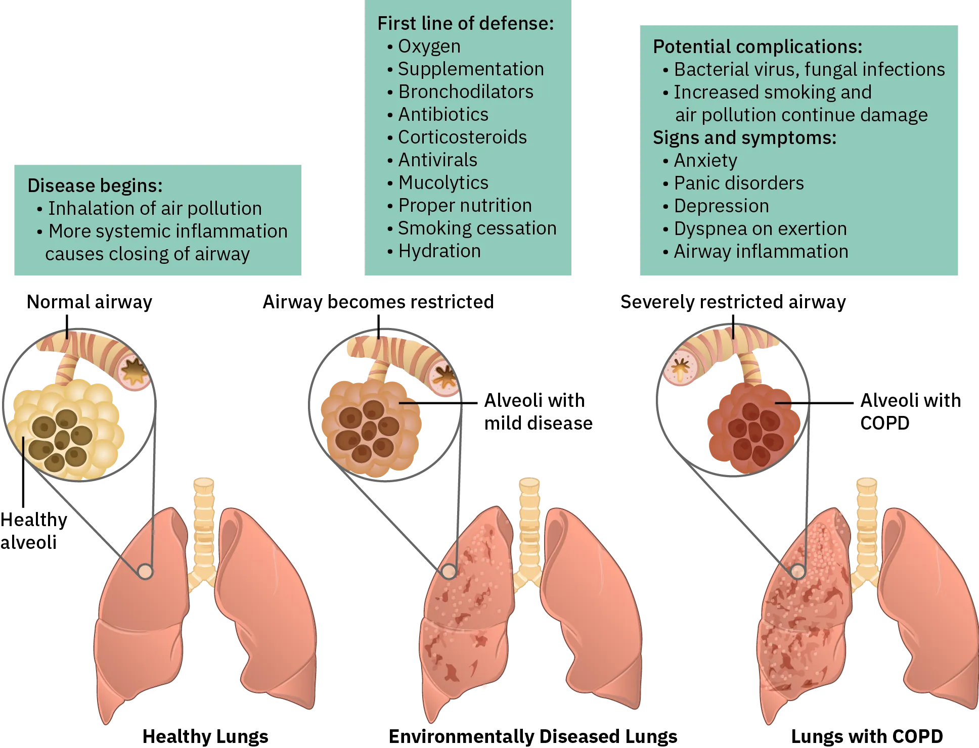 A diagram of the stages of C O P D from healthy lungs, to environmentally diseased lungs, to lungs with C O P D. Healthy lungs have an open airway and alveoli that are light colored. The lungs are a uniform shade of pink. Environmentally diseased lungs have an airway that is narrower than normal and alveoli that are slightly darker. The lungs have a few darker colored patches on them. Lungs with C O P D have a severely restricted air way with barely any opening. The alveoli are quite dark and appear hardened. The lungs have many dark spots throughout. The disease begins with inhalation of air pollution and more systematic inflammation causes the closing of the airway. The first line of defense includes oxygen, supplementation, bronchodilators, antibiotics, corticosteroids, antivirals, mucolytics, proper nutrition, smoking cessation, and hydration. Potential complications of C O P D include bacterial virus, and fungal infections and increased smoking and air pollution will continue the damage. Signs and symptoms include anxiety, panic disorders, depression, dyspnea on exertion, and airway inflammation.