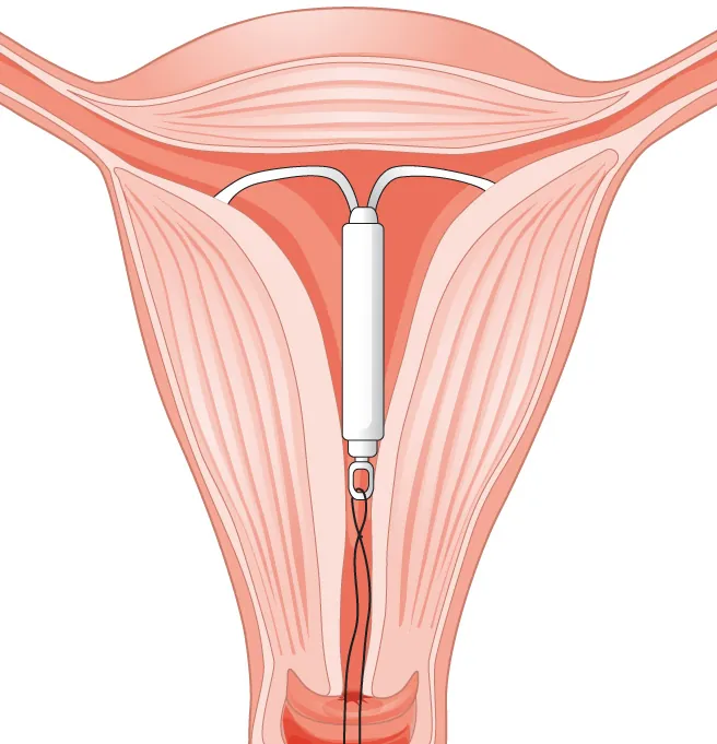 Image of wing-shaped intrauterine device inserted into uterus with string hanging down through the cervix.