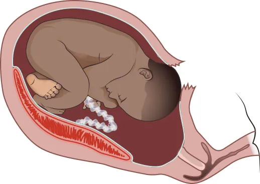 Image of uterus rupturing before delivery of fetus.