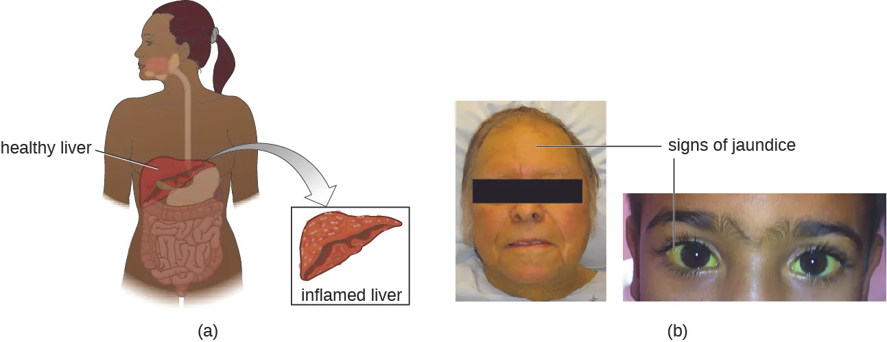 A) Shows an illustration comparing a healthy liver to an inflamed liver. B) A woman with yellowing eyes is shown and another with yellowing skin.
