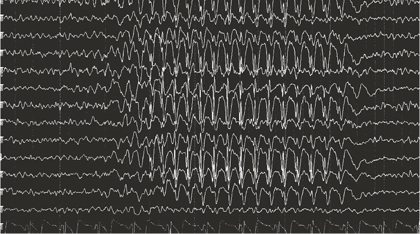 The EEG signature of absence epilepsy is the generalized 3 Hz spike-wave discharge. The chart is black with white waveforms.