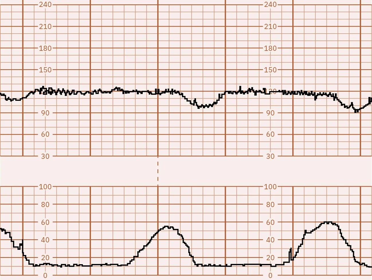 Fetal monitor tracing graphic depicting positive CST. Top strip displays dips in lines after second strip shows spikes.