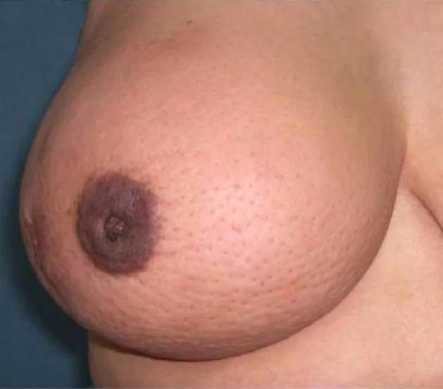 Photo of one breast engorged with “orange peel” type skin texture and flattened nipple.