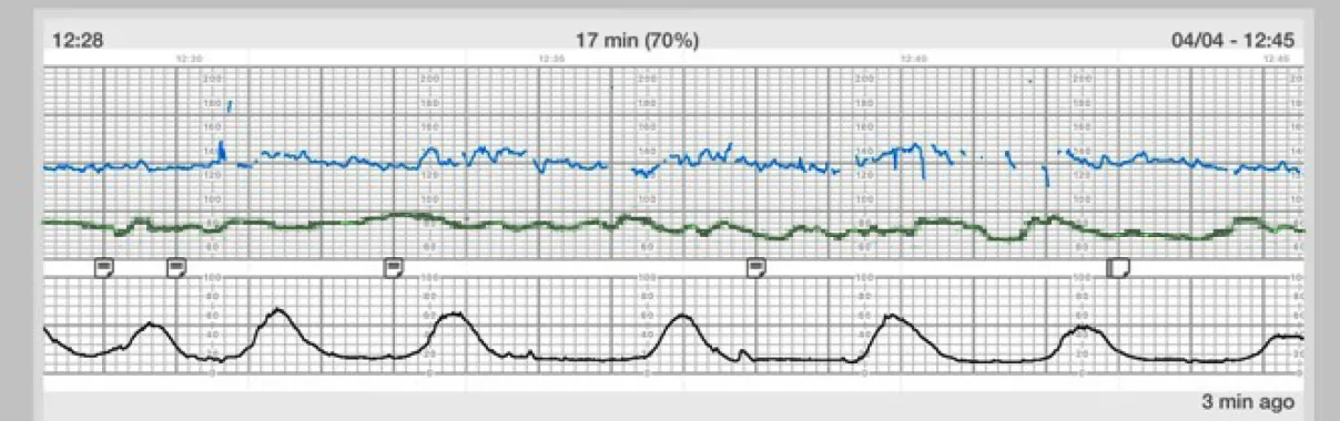 A three-tiered electronic fetal monitoring strip. The top tier shows an orange line for the fetal heart rate, the middle tier displays a purple line for the toco transducer measuring uterine contractions, and the bottom tier illustrates a white line for another parameter. The background is dark with grid lines, and there are timestamps and percentages indicating duration and progress at the top.