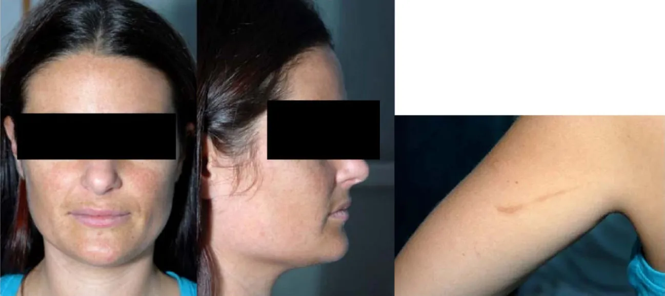 Photo of individual with hyper-pigmentation on their face (front and side views) and on their arm.