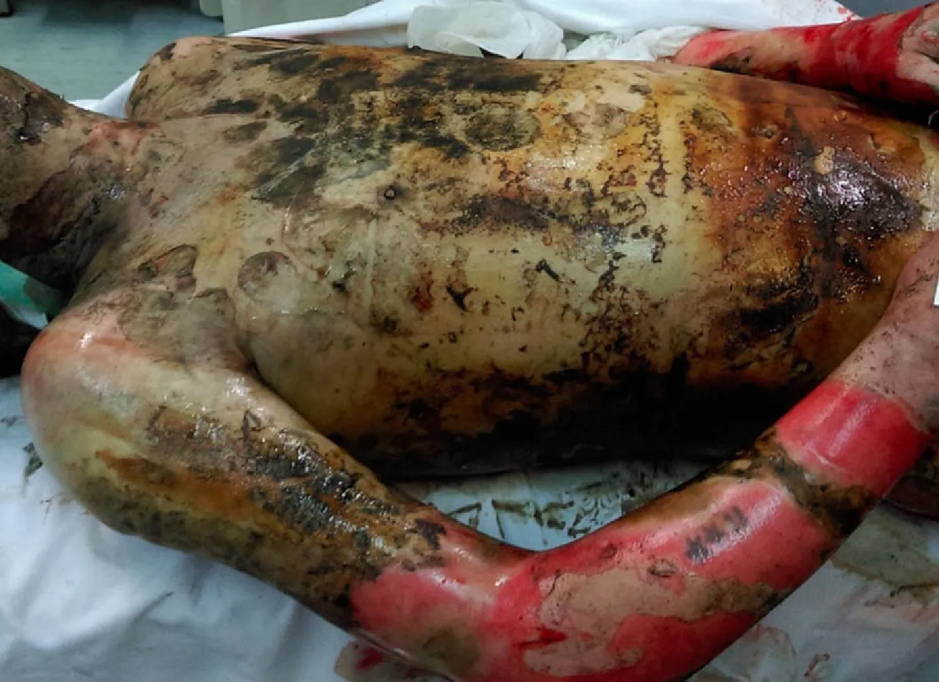 An image showing third and fourth degree burns on a patient.