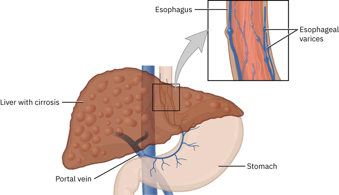 Illustration showing liver with cirrhosis, labeling Portal vein and Stomach; Inset shows varices in esophagus, labeling Esophageal varices.
