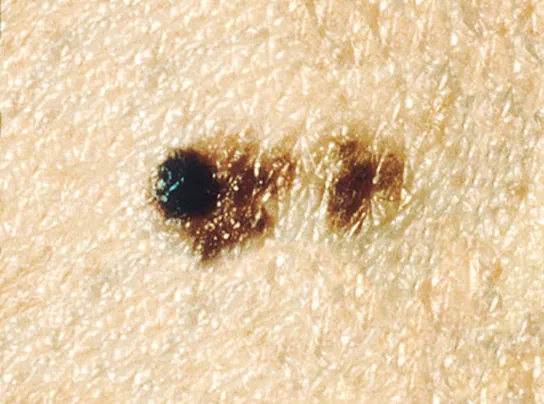 A close-up photo of light colored skin with a small dark, irregular and spreading patch of skin. Part of the dark patch looks like a slightly elevated mole.