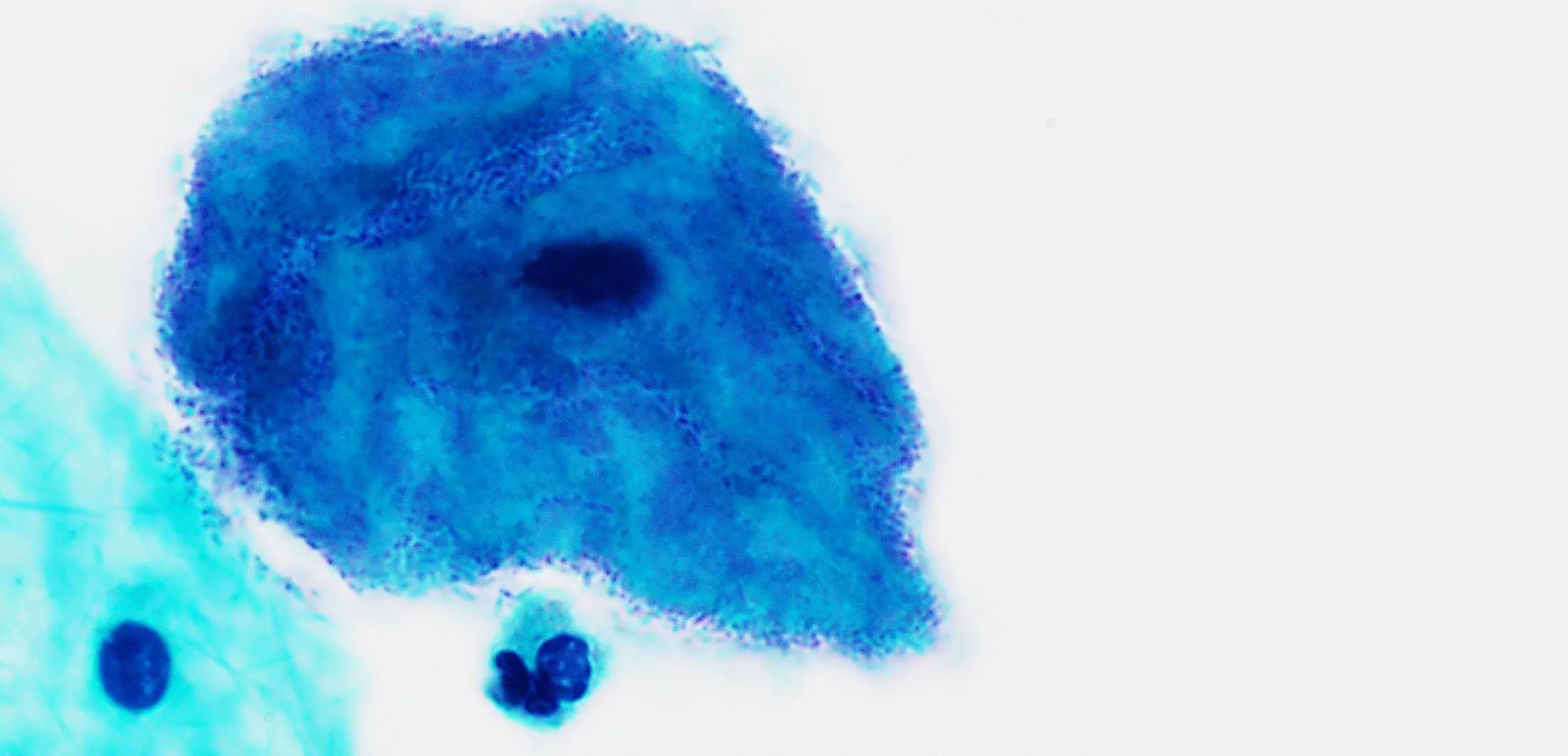 An image of a pap stain with a micrograph of a clue cell (center), covered in bacteria. An unremarkable squamous cell is located at the bottom left, and a neutrophil at bottom center.