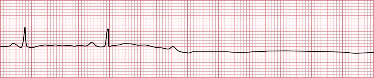 Sinus rhythm showing bradycardic rhythm with T waves not captured until strip goes flat with no evidence of ventricular activity.