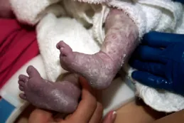 Photo of white, dry, cheese-like substance covering infant’s purple-looking feet.