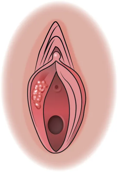 Image of the vulva displaying with small, round, light colored sores.