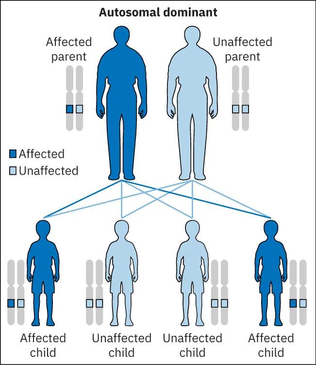 Autosomal dominant chart displaying how Affected parent and Unaffected parent combine and children are Unaffected and Affected.