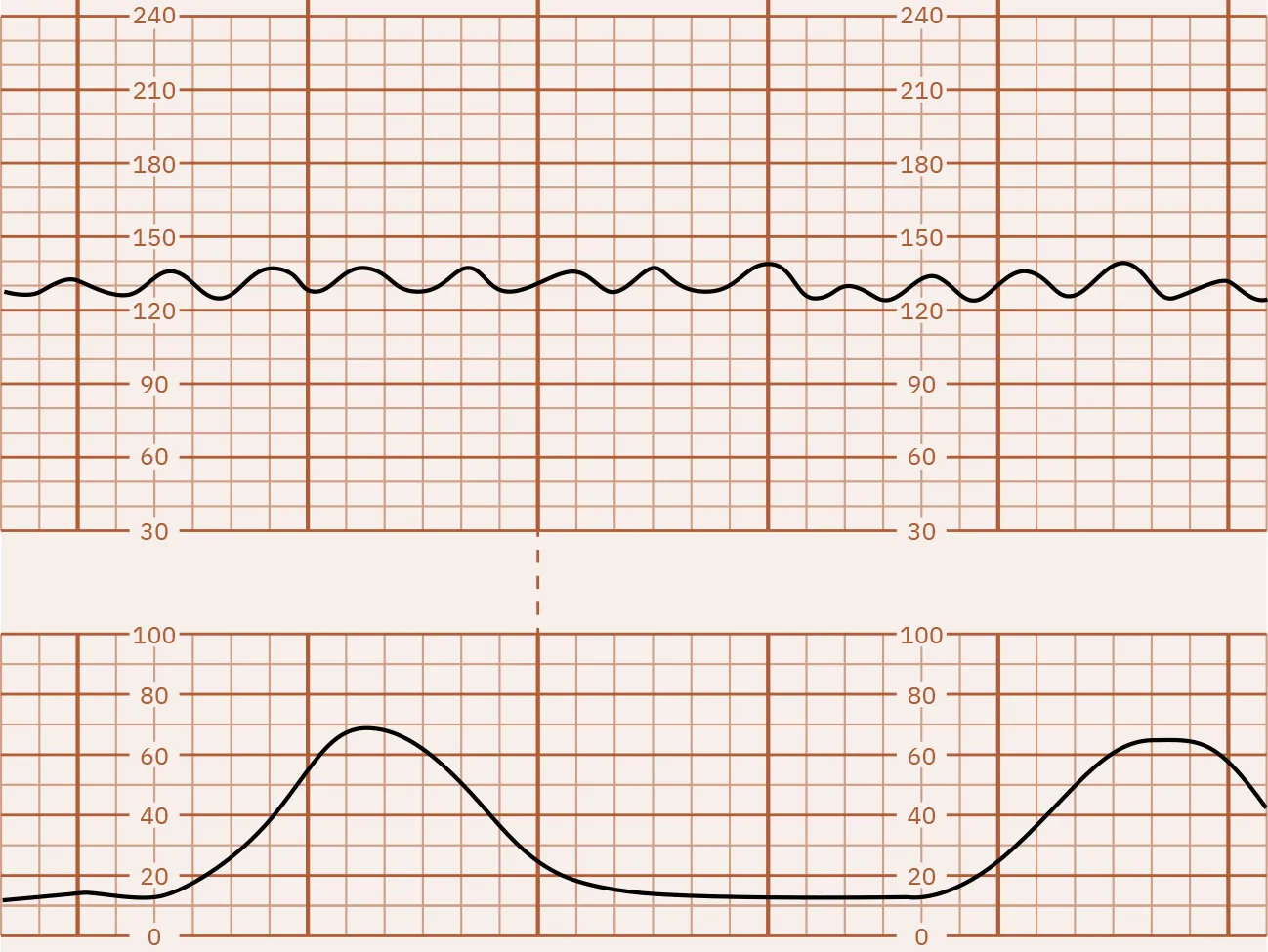 Fetal heart rate reading indicating a sinusoidal pattern.