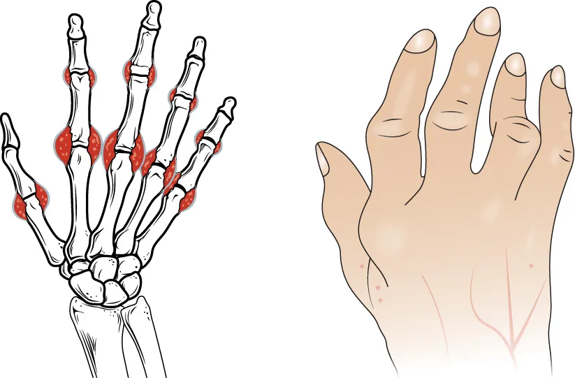 Diagram of hand bones and hand showing RA nodules present on the knuckle joints