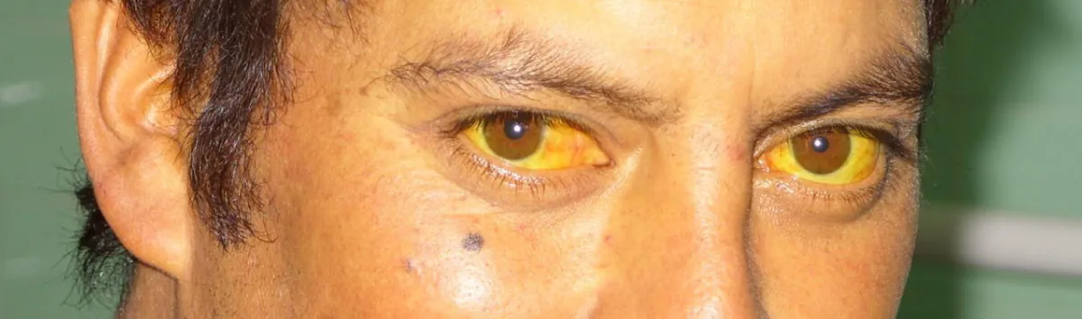 A patient with yellow eyes due to jaundice