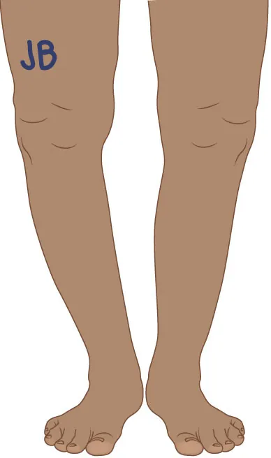 An illustration of a leg shows the initials JB written above the right knee to indicate the correct surgical site.