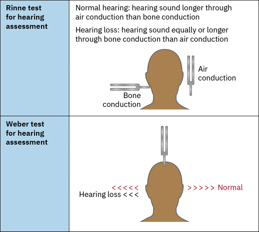 A diagram of (upper part) Rinne and (lower part) Weber tests for assessing hearing.