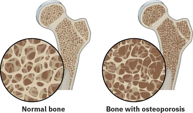 Diagram showing normal bone and bone with osteoporosis