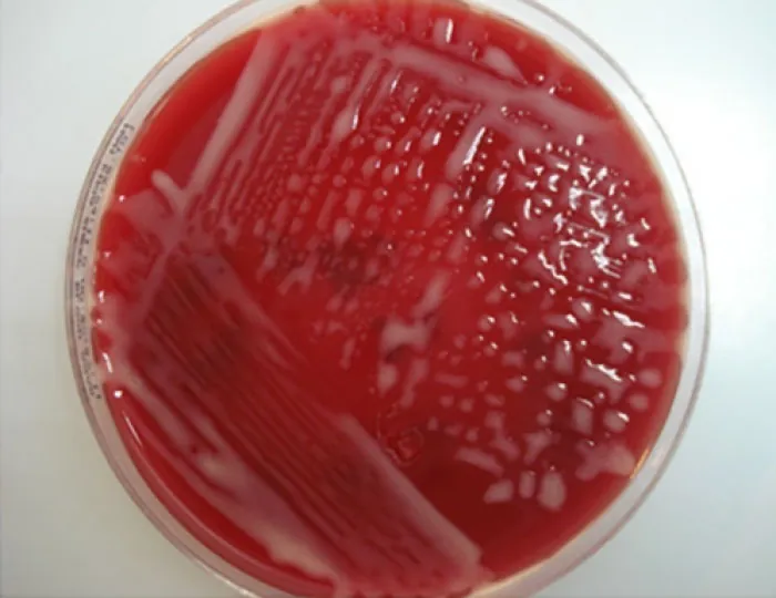 Petri dish with a sample of sputum.