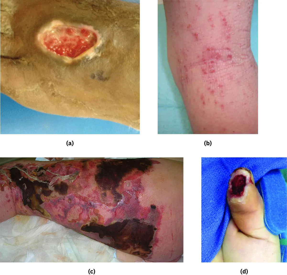 Examples of different types of wounds: (a) a venous insufficiency ulcer, (b) excoriation, (c) infection from necrotizing fasciitis, and (d) a traumatic injury.